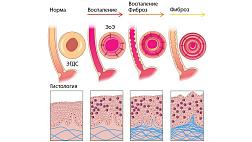 ЭОЗИНОФИЛЬНЫЙ ЭЗОФАГИТ - астма пищевода?
